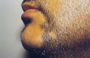 Alopecia Barbae  Beard Symptoms Causes Treatments  Beard Patches   YouTube