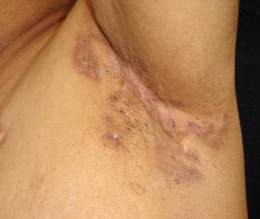 Hidradenitis suppurativa: Signs and symptoms