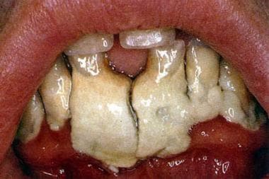 Dental calculus accumulations on the mandibular an