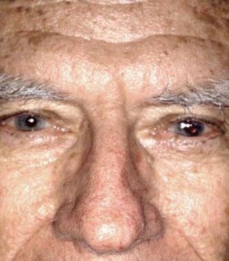 Three months postrepair with a well-blended scar l