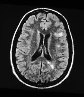 MRI of the head of a 35-year-old man with relapsin