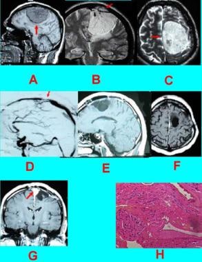 Case 7: Parasagittal meningioma invading the super