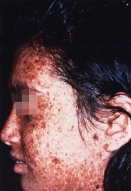 Sunlight-induced dermatologic abnormalities in a p