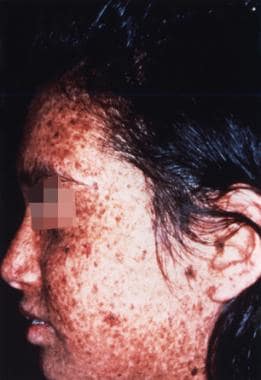 Sunlight-induced dermatologic abnormalities in a p