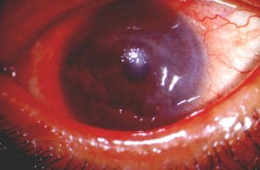 Ocular rosacea. Extensive corneal pannus with thin