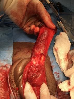 Concomitant urethral injury with visible Foley cat