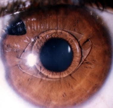 Phakic myopia iris claw lens, 11 years postoperati