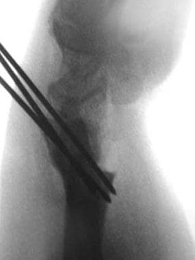 Postoperative lateral radiograph. Note dorsal tran