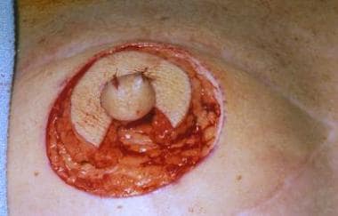 Intraoperative sequence of nipple reconstruction w