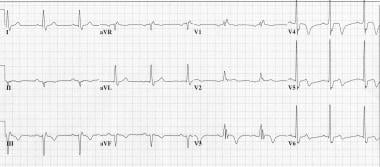 Classic Wellens syndrome T-wave changes. ECG was r
