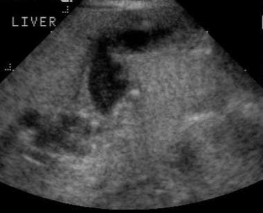 Diagnostic ultrasonogram demonstrating a type I ch