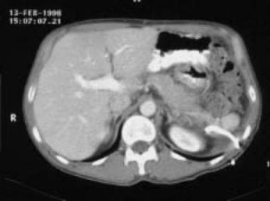 Chronic pancreatitis. This follow-up CT scan (see 