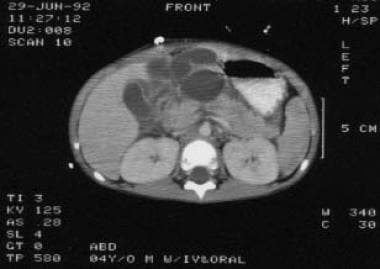 Pediatric Pancreatitis. Computed tomography (CT) s