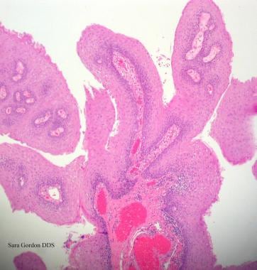 Infectia cu virusul papiloma uman (HPV) | dieta-daneza.ro