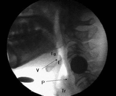 Lateral projection of the videoprint of a videogra