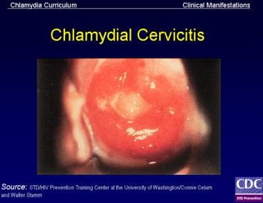 Signs of chlamydial cervicitis on speculum examina