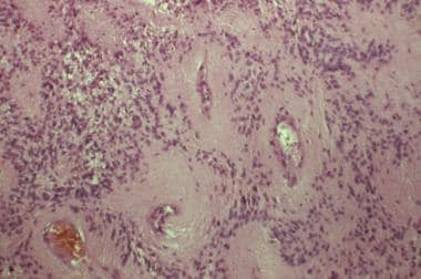 Histologic study of a classic ependymoma. Note the