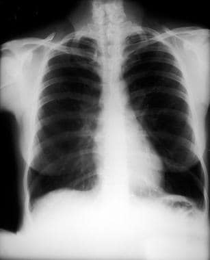 A lung with emphysema shows increased anteroposter