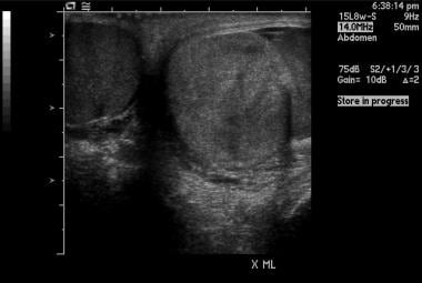 Transverse scrotal ultrasound image shows left int