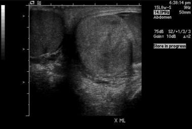 testicular rupture ultrasound