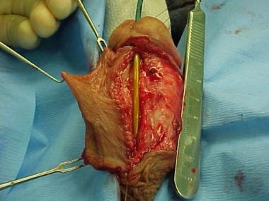 Urethral strictures. Photograph depicting pedicled
