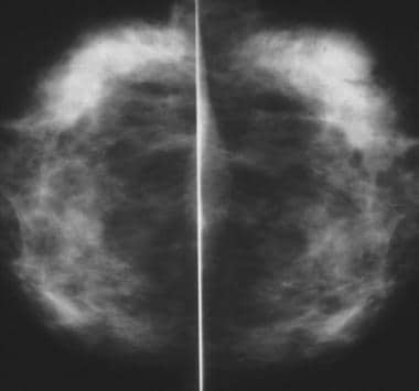 Craniocaudal mammograms obtained 1 year apart demo