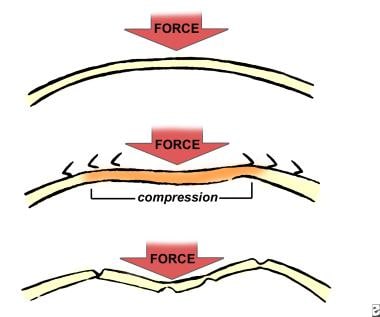 The compressive force of frontal bone as the bone 