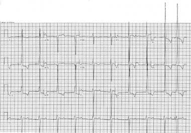 Dilated Cardiomyopathy Ecg