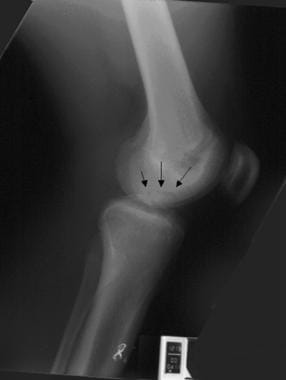 Lateral radiograph of osteochondritis dissecans. 