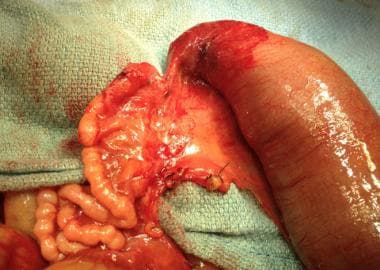 Surgical image of newborn with type IIIa ileal atr