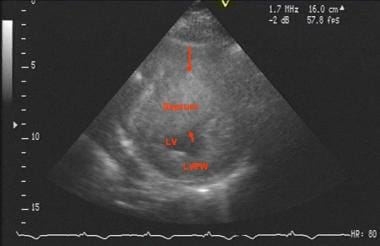 Echocardiogram, short-axis view in systole, in the