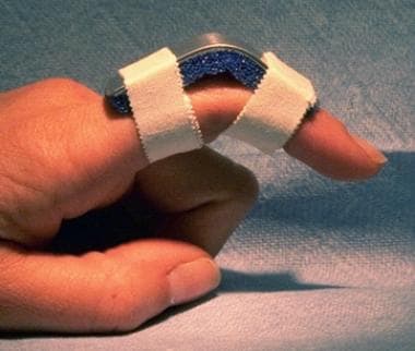 Extension block splint with the proximal interphal