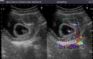 This was a live embryo with a large subchorionic h