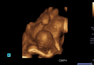 A 3D antennal ultrasound scan shows an omphalocele