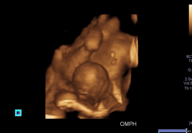 anencephaly 3d ultrasound