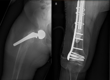  Periprosthetic fracture at stem of hip replacemen