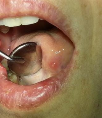 Recurrent aphthous ulcer with well-defined erythem