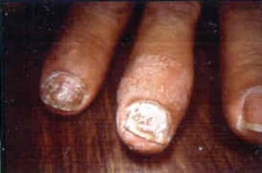 nail psoriasis medscape