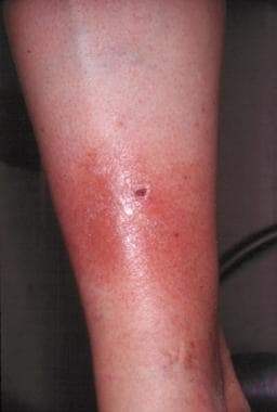 Erythema nodosum. 