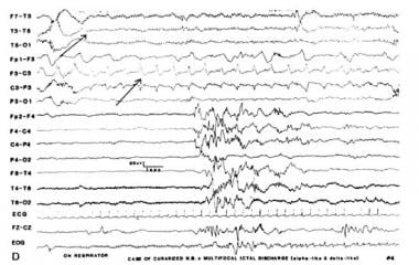 Infant with L electrographic seizure with multifoc