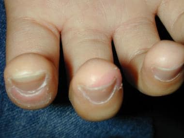 Peeling and erythema of the fingertips. 