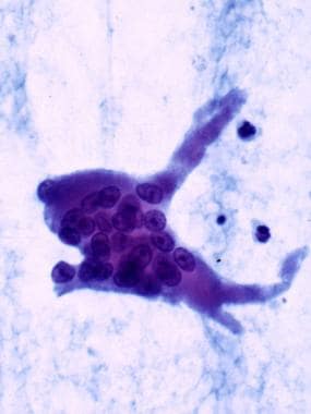 Osteoclast in a cytologic preparation (Papanicolao