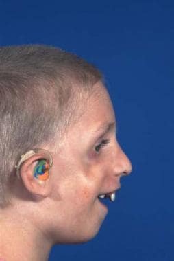 Treacher Collins syndrome. Preoperative appearance