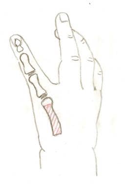A right hand with aplasia of the thumb. The shaft 