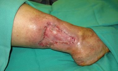 Skin graft affixed to recipient bed using surgical