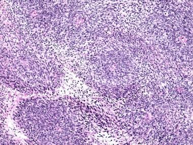 Pathology of prostatic stromal sarcoma. Medium mag