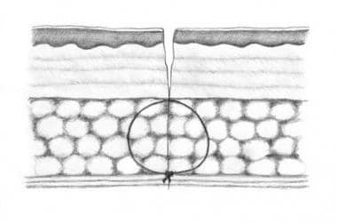 Deep absorbable stitches should be placed so that 