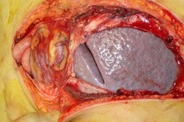 Left oblique abdominal incision showing severe (ma