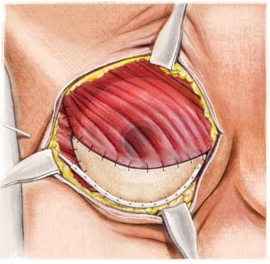 Delayed Breast Reconstruction  UPMC Western Maryland Plastic Surgery