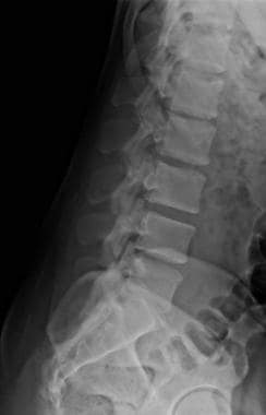 Lateral radiograph of lumbar spine and sacrum. 